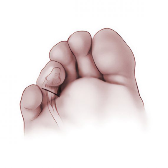 Curly toes | CLLC Montréal, Dre Marie Gdalevitch
