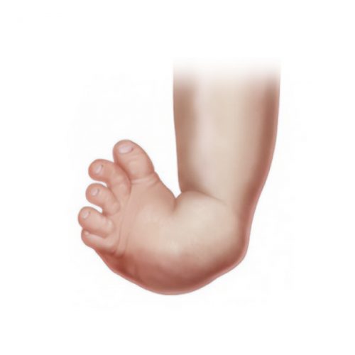 Clubfoot deformity