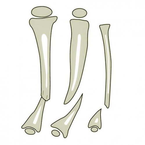 Anterolateral bowing of tibia