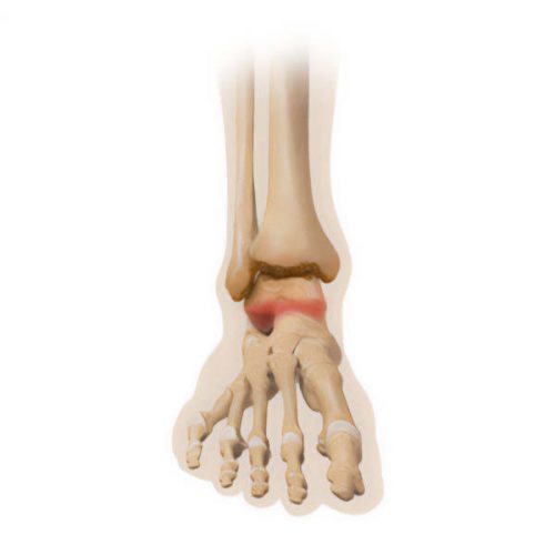 Hindfoot arthritis and deformity