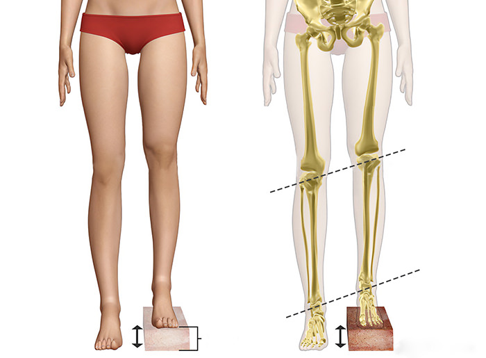 Leg Length Discrepancy: Ways You Can Correct It