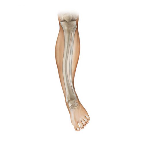 Postero-medial bowing of tibia