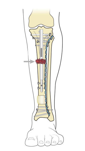 Bone Transport  International Center for Limb Lengthening