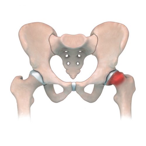 Épiphysiolyse fémorale supérieure (EFS) ou glissement épiphysaire de la hanche