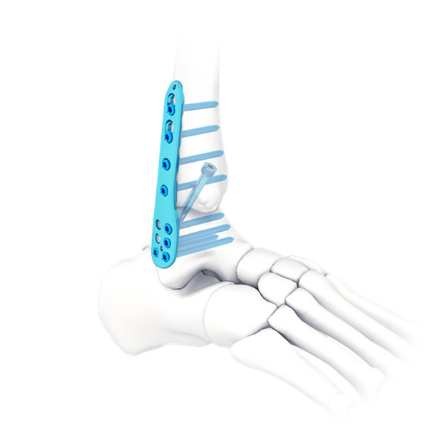 A novel technique to remove a broken tibiotalocalcaneal intramedullary nail  using Moreland hip revision instrumentation | The Annals of The Royal  College of Surgeons of England