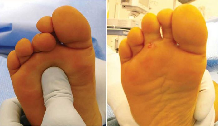 Lesser Toe Tenotomy Flexor tenotomies for curly toes | CLLC Montréal, Dre Marie Gdalevitch