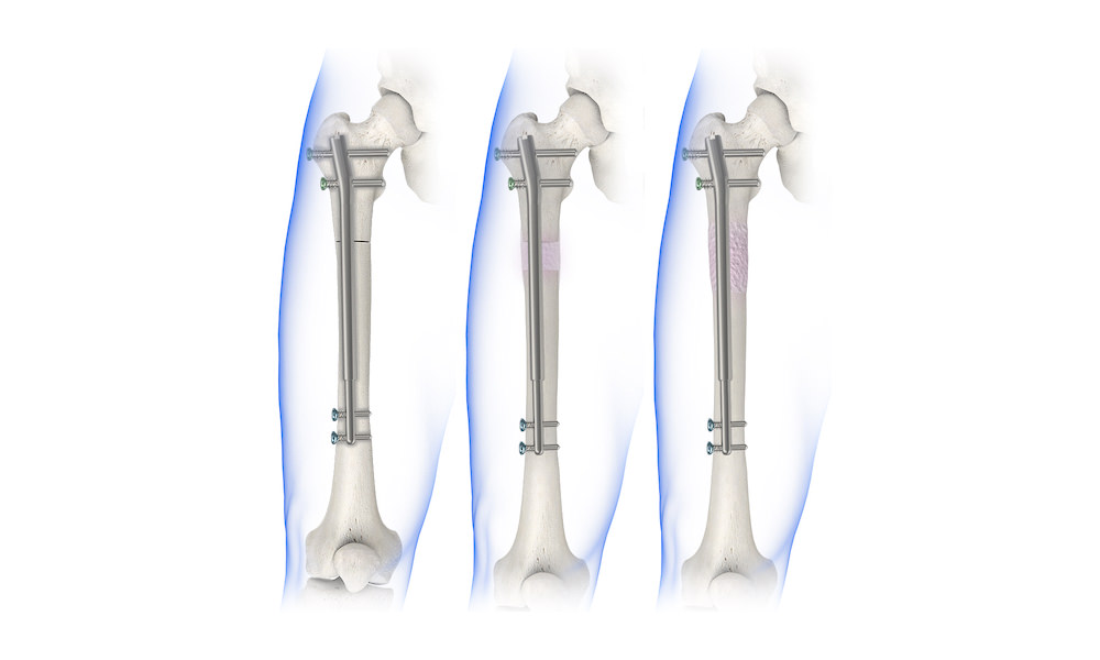 PDF) Leg Lengthening With a Motorized Nail in Adolescents